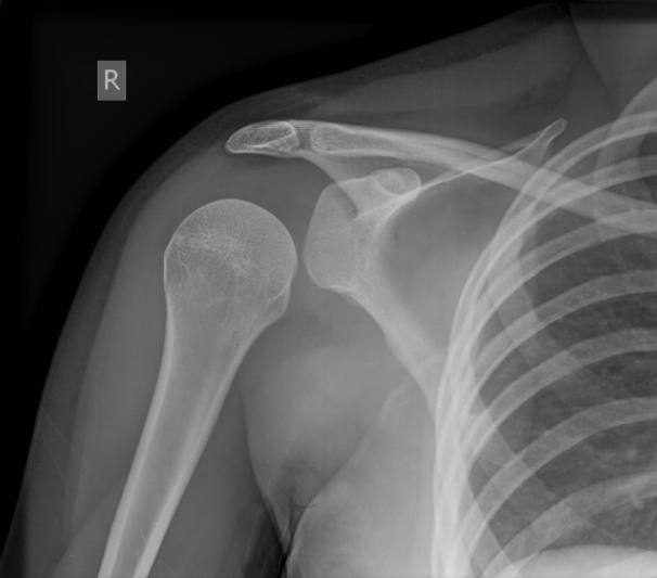 posterior shoulder dislocation 007